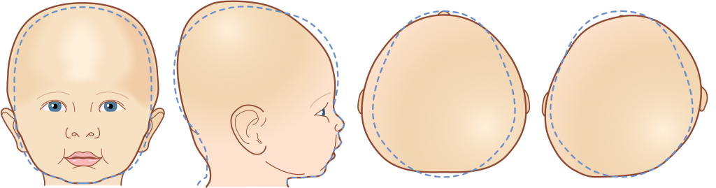 brachycephaly cranial helmet