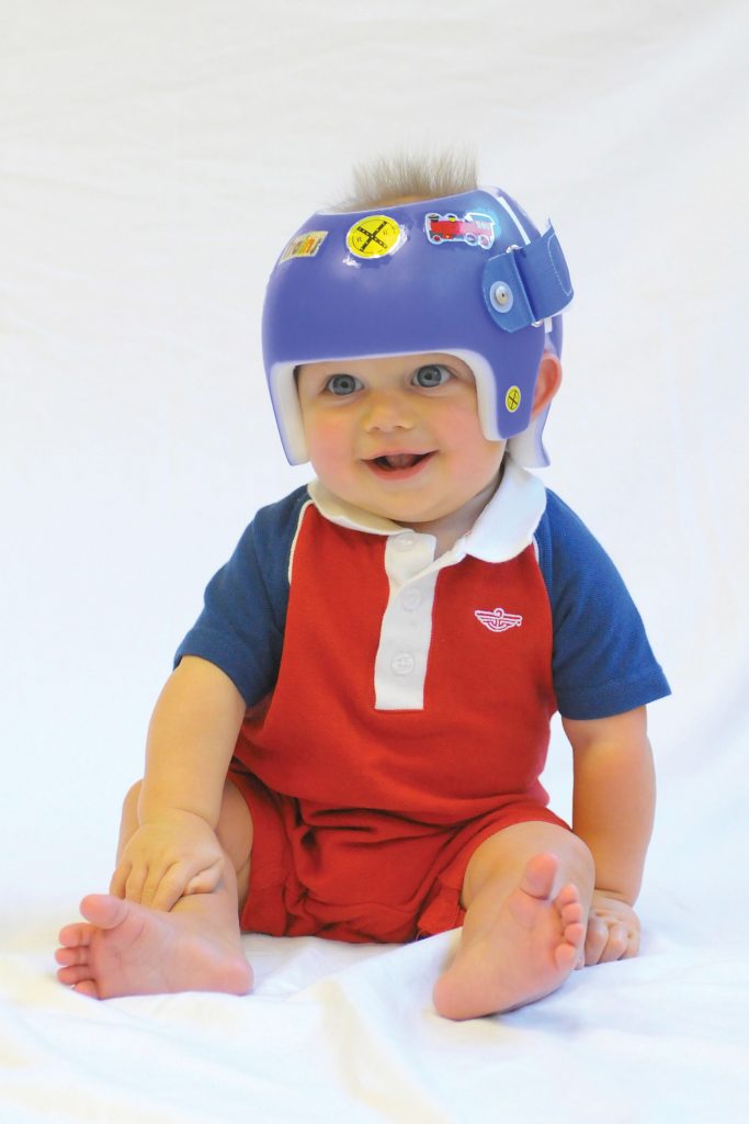 Owens Carolina Is Your Pediatric Cranial Molding Helmet Specialist Designing Comfortable And Fun Children S Orthotics In Charlotte Mooresville And Lake Norman